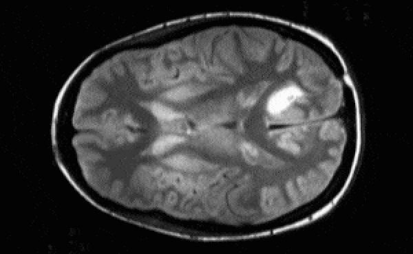 Segmentation on a brain image